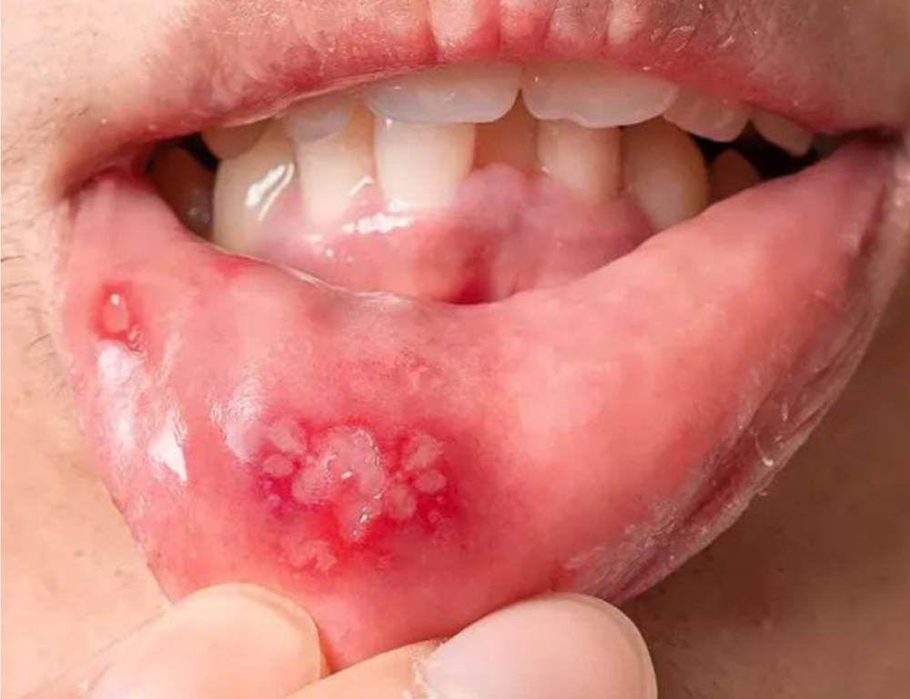 Close-up of a person's lower lip showing painful mouth ulcers, often associated with autoimmune diseases like Rheumatoid Arthritis (RA)