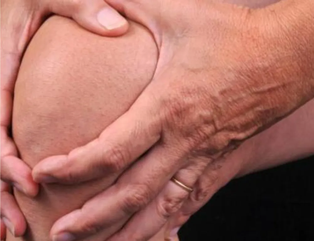 Close-up of a person holding their knee in pain, indicating joint discomfort and inflammation, common in severe arthritis