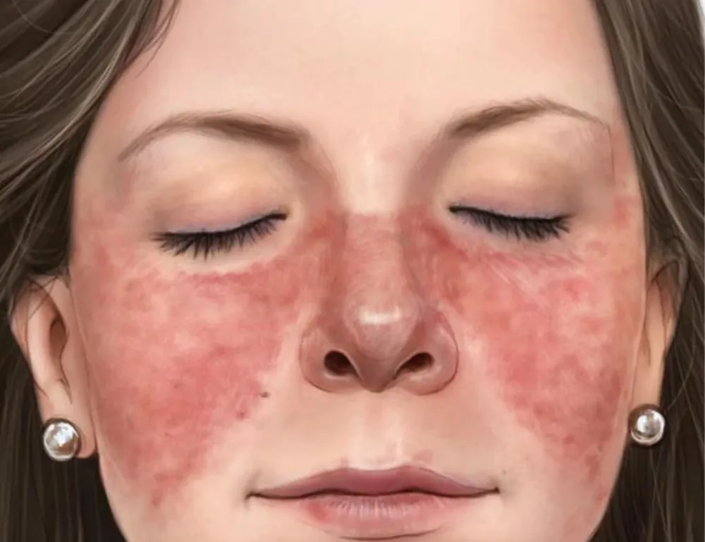 Close-up of a person's face with a red butterfly-shaped rash across the cheeks and nose, indicative of Lupus, an autoimmune disease