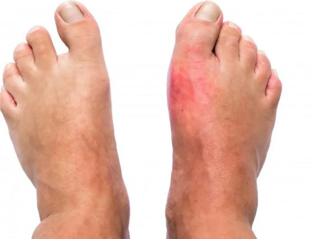 Close-up of a person's feet, one of which is inflamed and swollen, indicating severe arthritis or gout