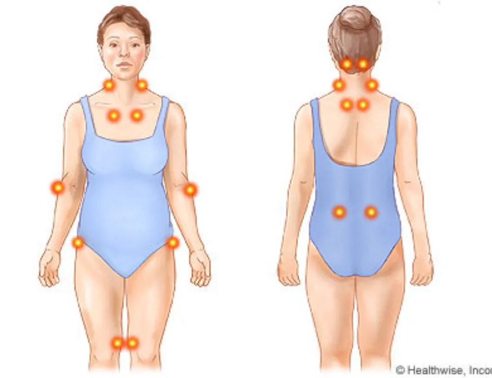 Pain Points in Fibromyalgia