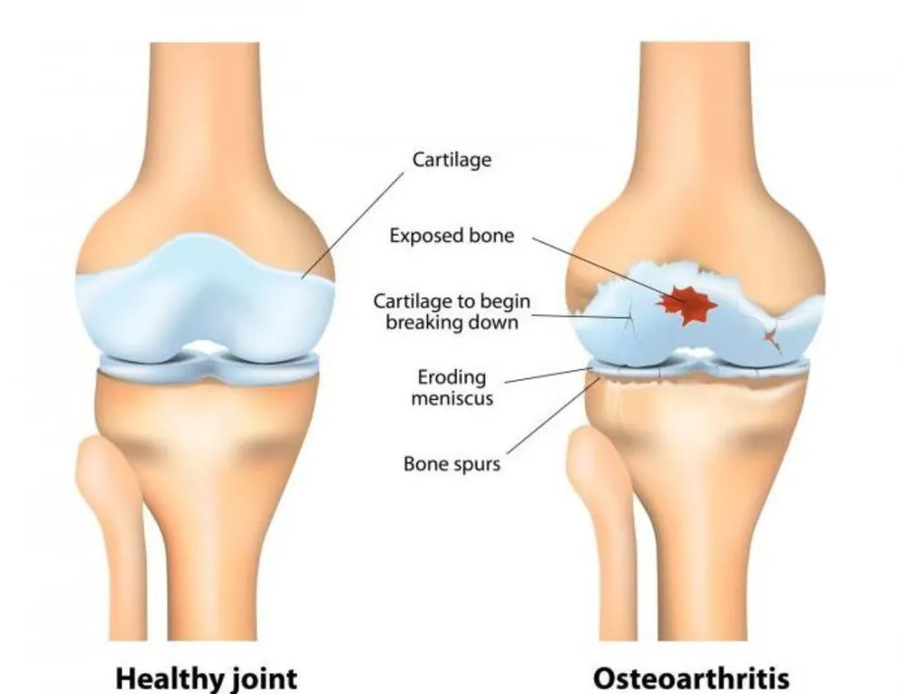 Comparison of a healthy joint and an osteoarthritic joint, showing cartilage breakdown, exposed bone, eroding meniscus, and bone spurs