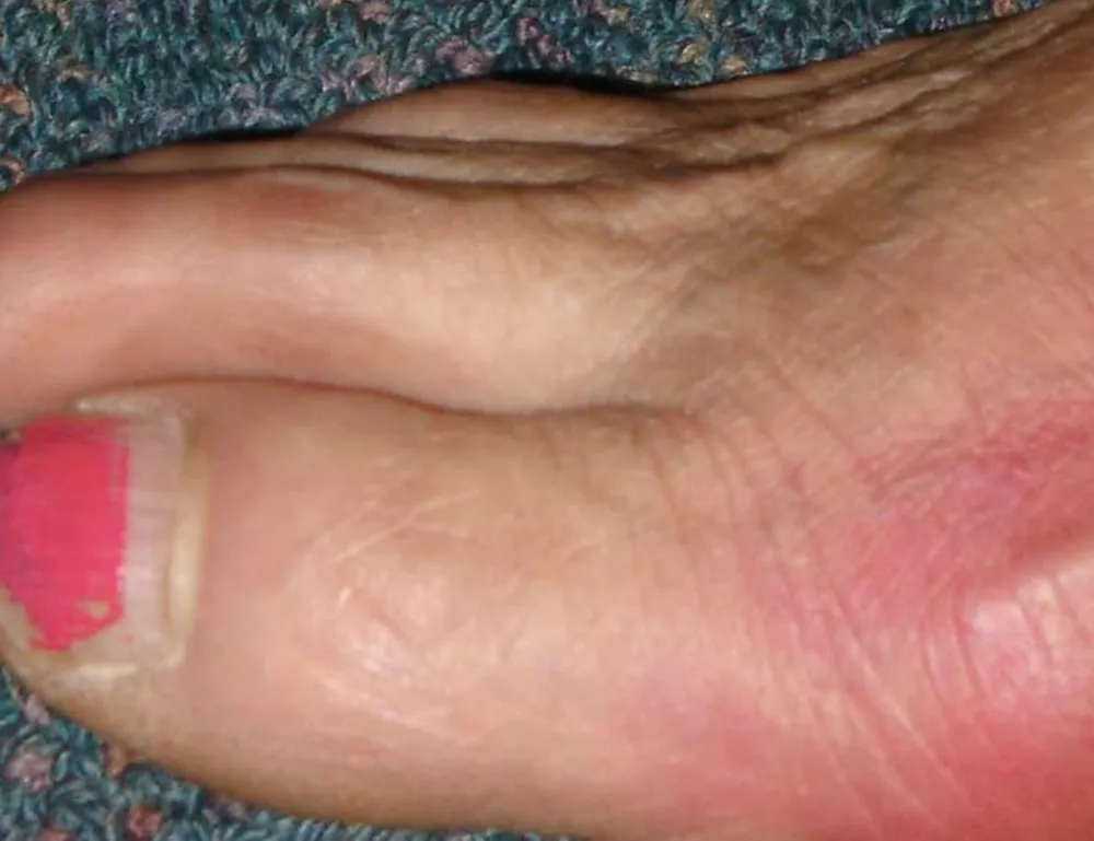 Close-up of a person's inflamed and swollen toe, indicating severe arthritis or gout