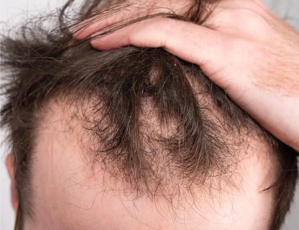 Close-up of a person's scalp showing hair loss, a possible side effect of autoimmune diseases like Rheumatoid Arthritis (RA)