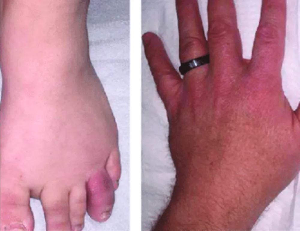 Images showing swollen foot and hand, common symptoms of severe arthritis, highlighting inflammation and joint pain