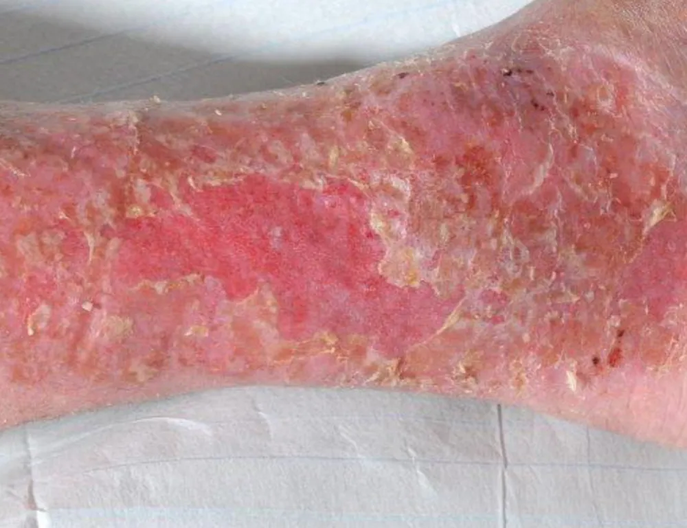 Close-up of a person's leg with severe skin rashes on dry skin, caused by arthritis