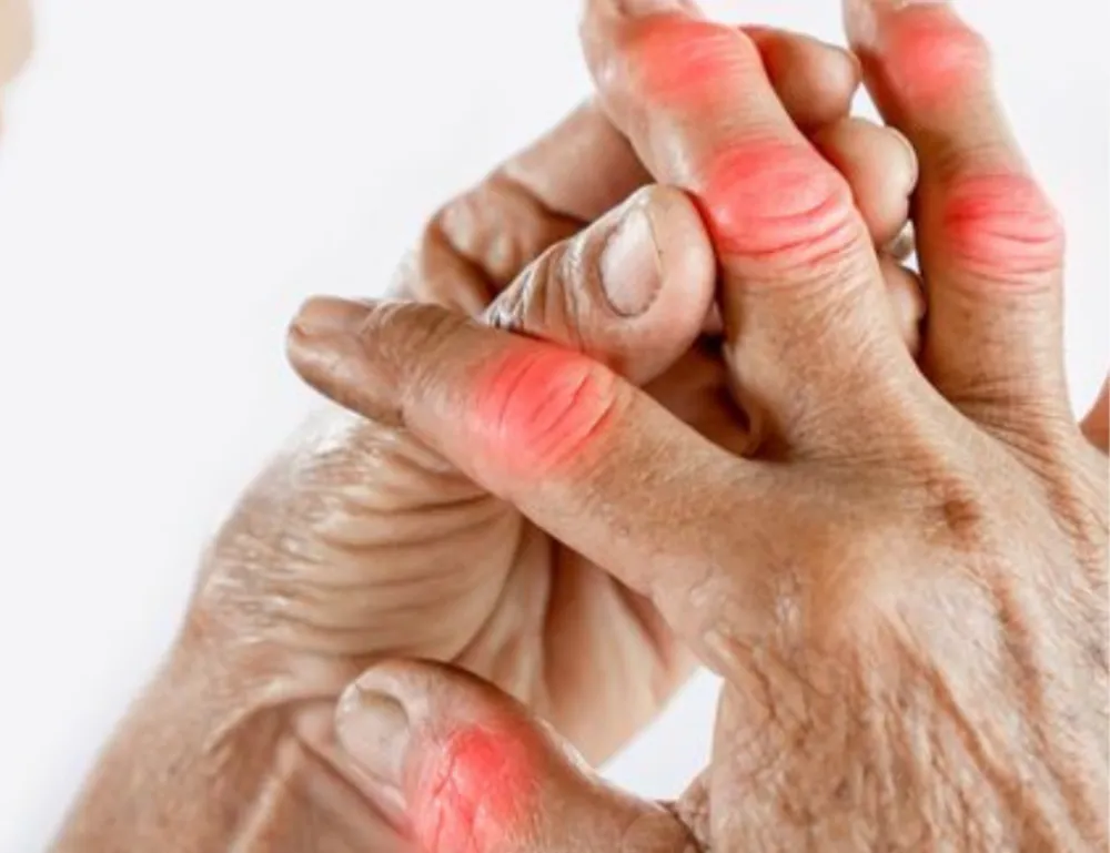 Close-up of a person holding their inflamed and swollen fingers, indicating severe arthritis