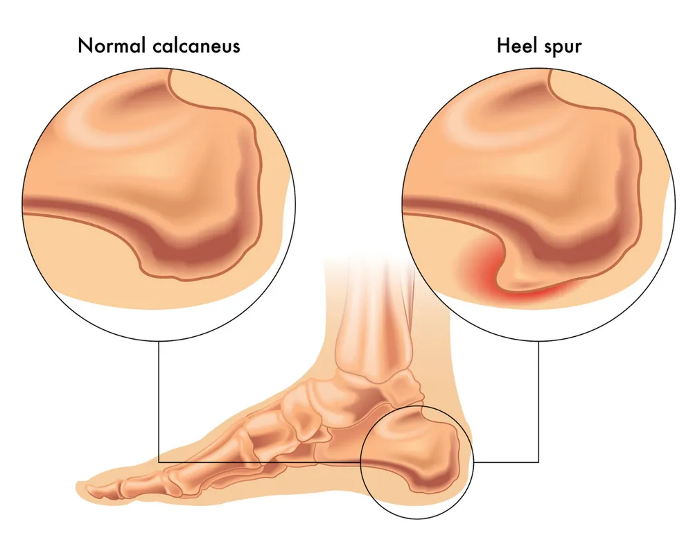 Comparison between a normal calcaneus and a heel spur, highlighting the bone growth on the heel causing pain